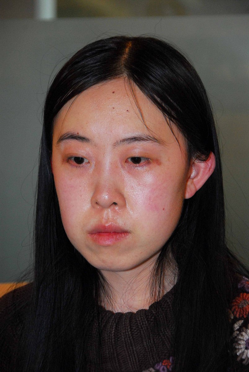 玻尿酸填充额头：改善皱纹凹陷，重塑完美额头