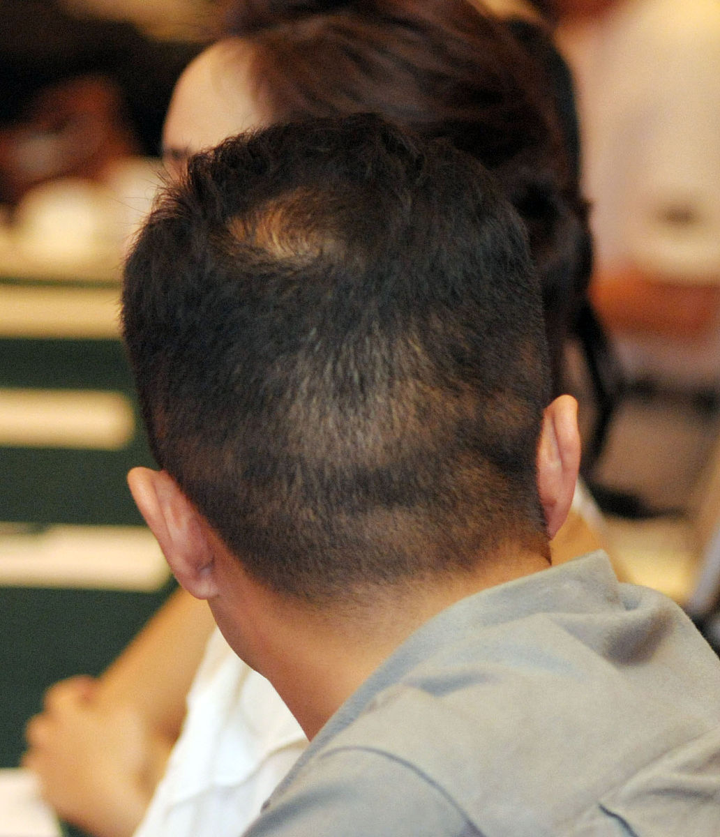 35岁男性脱发、白发增多怎么办？有效改善方案