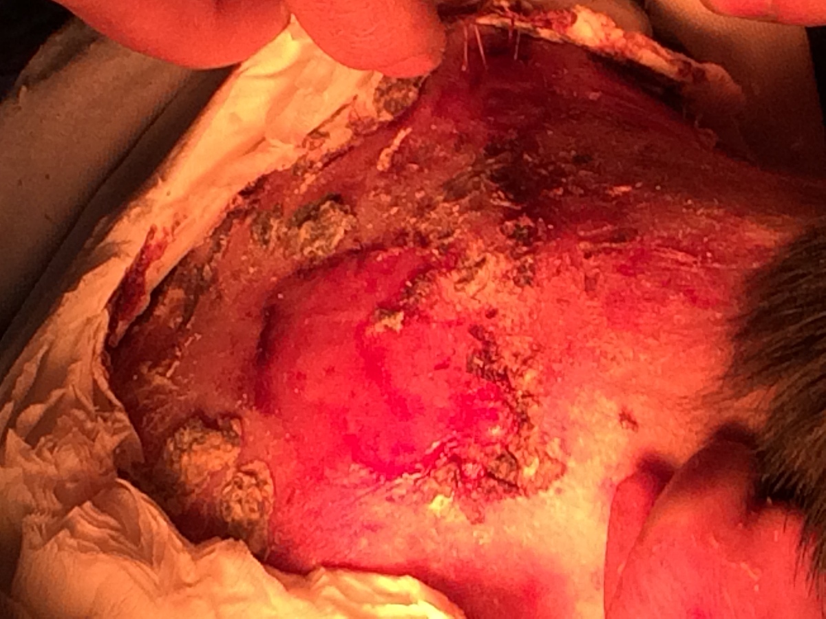 胸腺囊肿需要做切除手术吗