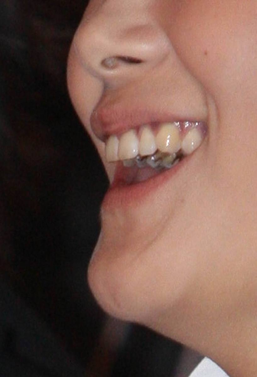 只有一边虎牙突出来是什么情况