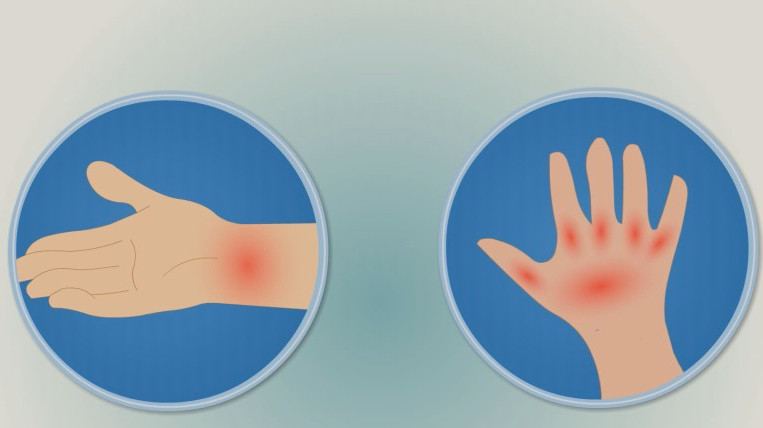 乌鸡白凤丸能治疗痛风吗?还是听听专业的建议吧