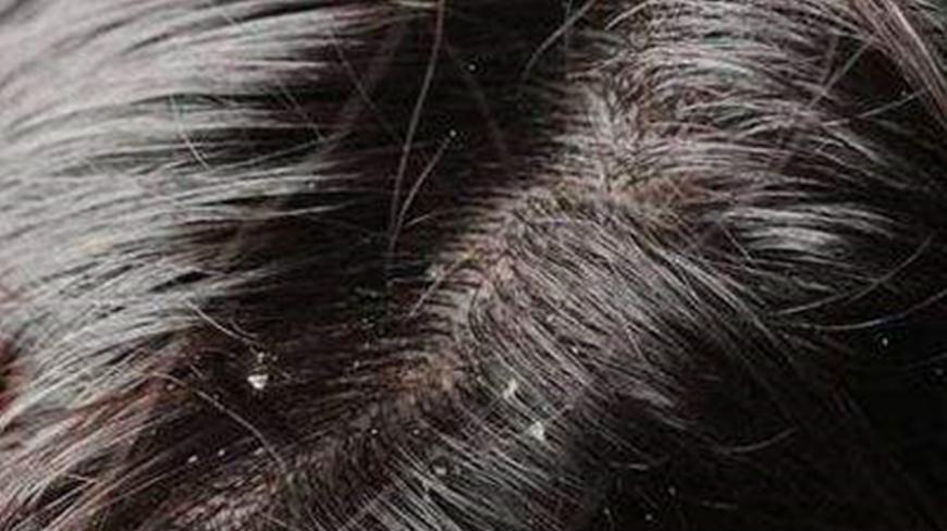 肝火太旺头发常油腻,3种食物帮你清肝降火,再也不怕油头尴尬