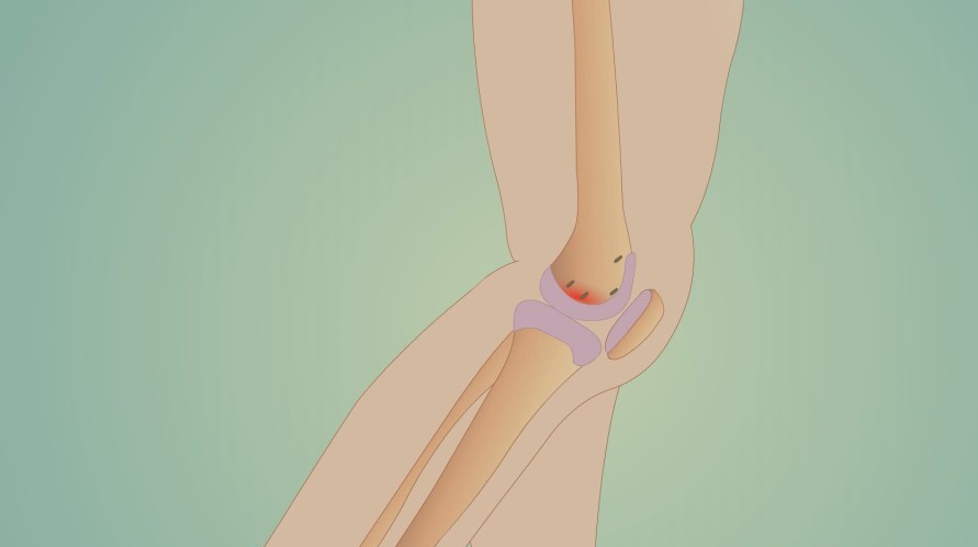 骨质疏松常见的症状有哪些?腰背疼、浑身关节疼、肌肉痉挛……