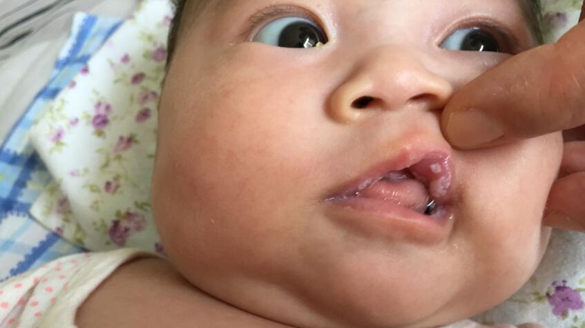 治疗小儿鹅口疮,艾灸疗法是良方!