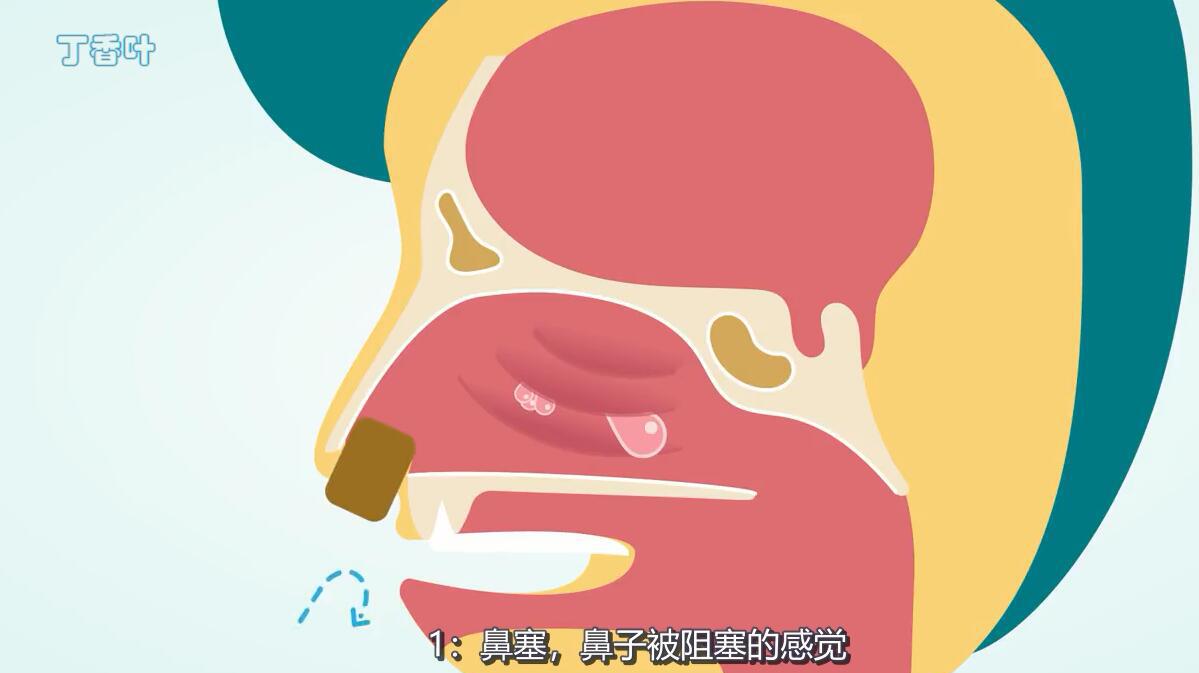 医学健康:什么是鼻息肉?