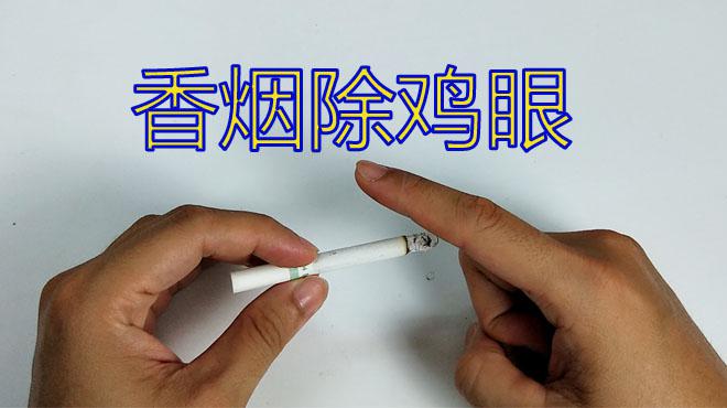 治疗鸡眼只用一根香烟?几乎零成本就可解决烦恼,你有没有试过?