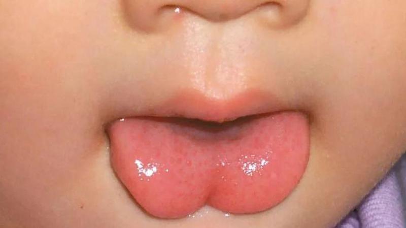 育儿:宝宝舌头是不是“W”型?如果是这种形状就一定要重视!