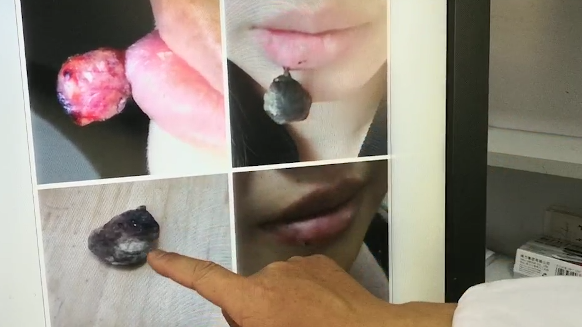 吓人!孕妇嘴唇痒 挠破后引发长出肉芽肿血管瘤