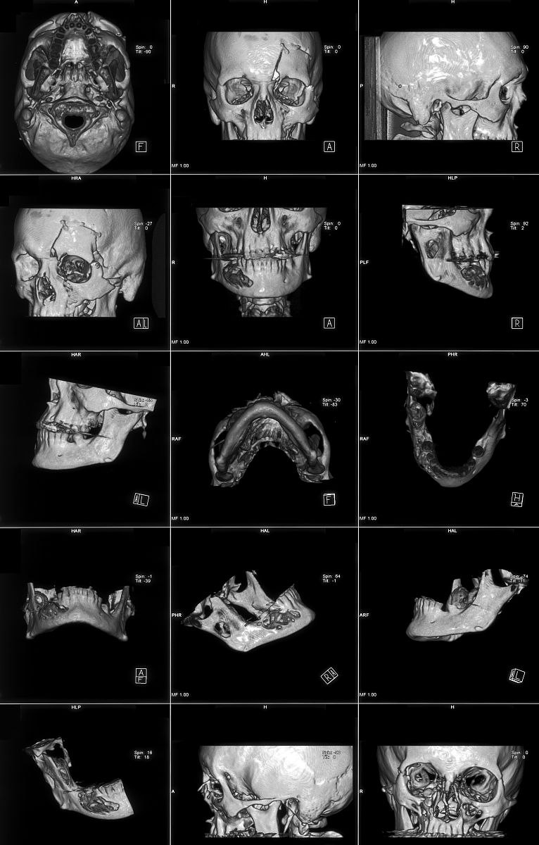 胚胎上颌隆起和下颌隆起：起源、发育与重要性