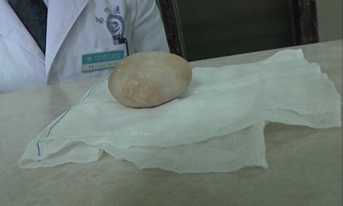 10年前鱼线掉进男子膀胱里,如今体内长出鹅蛋大小结石