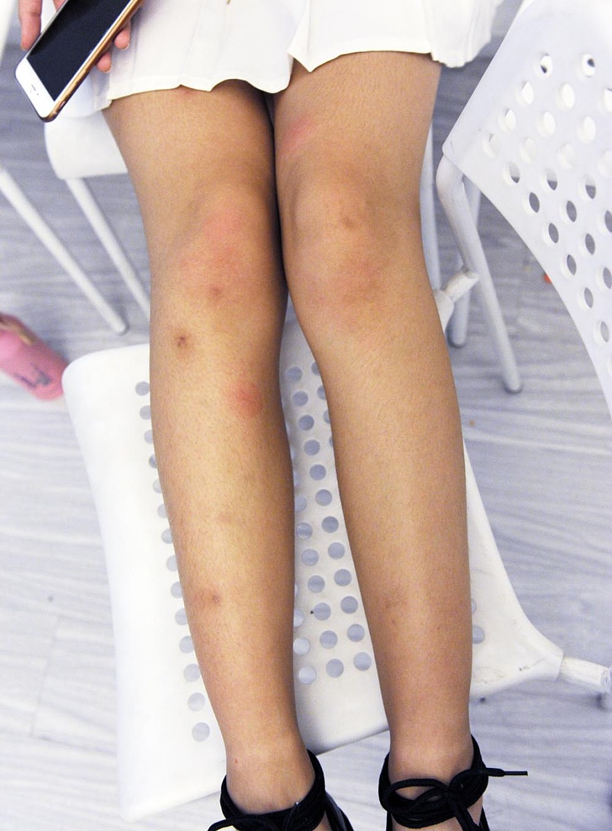 大腿皮肤按下去凹陷且长时间不恢复是有什么问题吗？