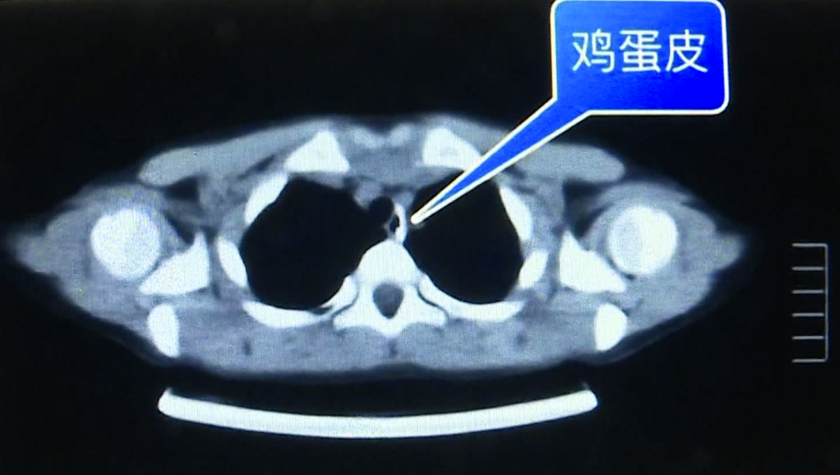 吃妈妈煮的鸡蛋面,6岁女童蛋壳卡食道,动脉险被扎破