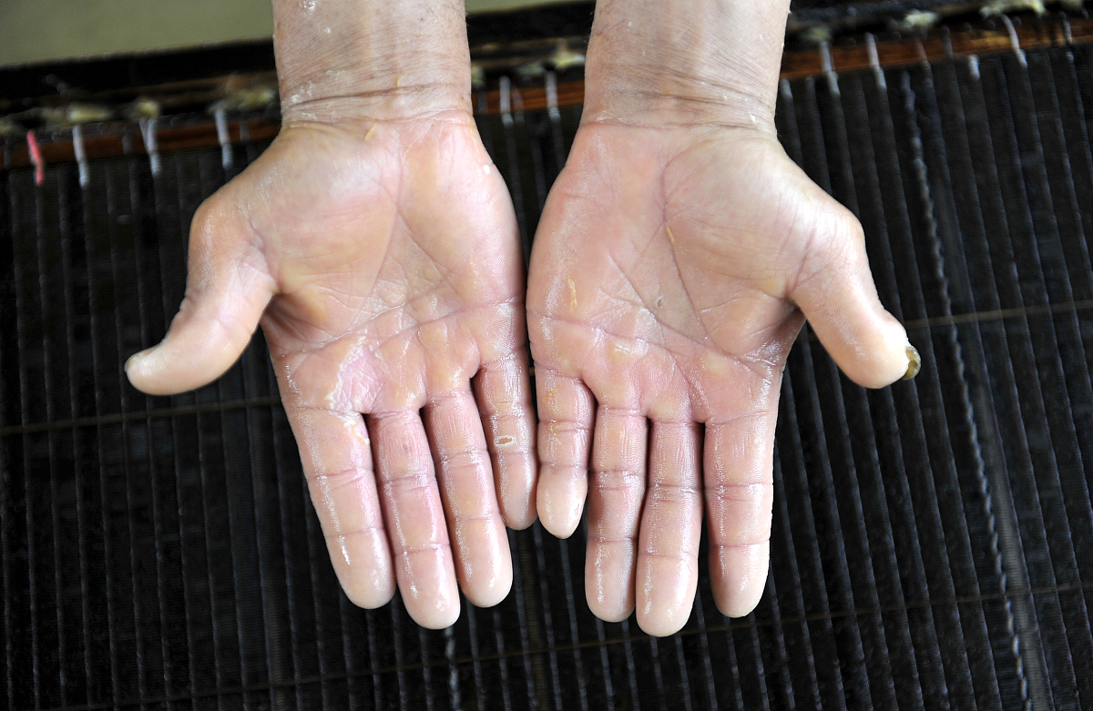 人手为什么会长老茧
