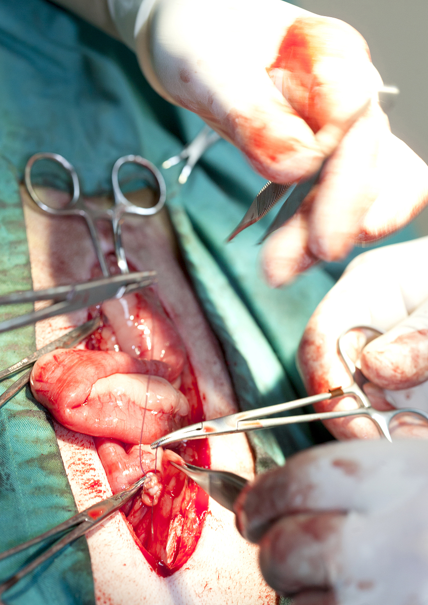 经腹全子宫及双侧输卵管切除术：治疗方法、风险与术后恢复