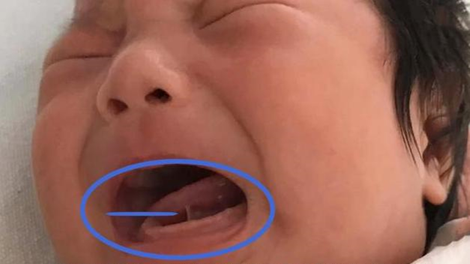 宝宝1岁还不会说话,奶奶怀疑没给娃剪舌根,医生:回去吧治不了