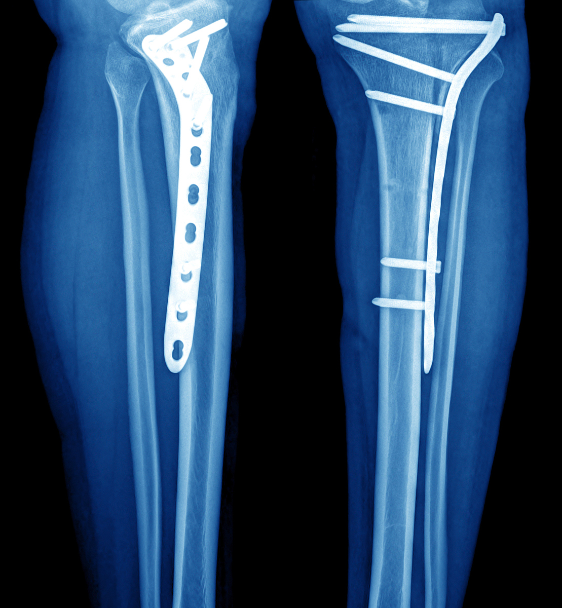 踝关节不稳手术治疗：病例分析与治疗方案