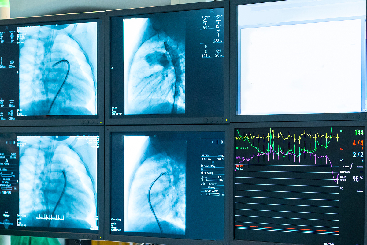 以学术化的内容对以下内容进行改造：模拟了速度为4ms的入口边界条件情况下三个不同狭窄程度气道模型所受的压力。如图3-2所示手术之前的狭窄气道的压力主要集中在气道狭窄处及狭窄处之前的气道部分气道受力最大处会承受300Pa以上的压力该结果与文献20中狭窄程度为50的模型模拟的结论相近故认为该计算结果有效。而术后气道在压力分布上则取得了巨大的改善在狭窄处之前及支气管道部分均有一定的压力值但压力值并不大气