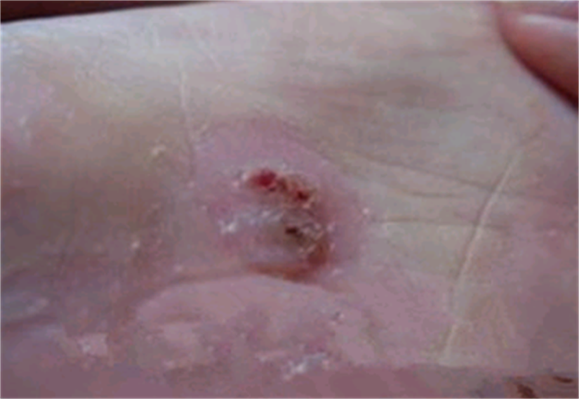 鸡眼疼痛难忍,这个小秘方收好了,快速根除不复发