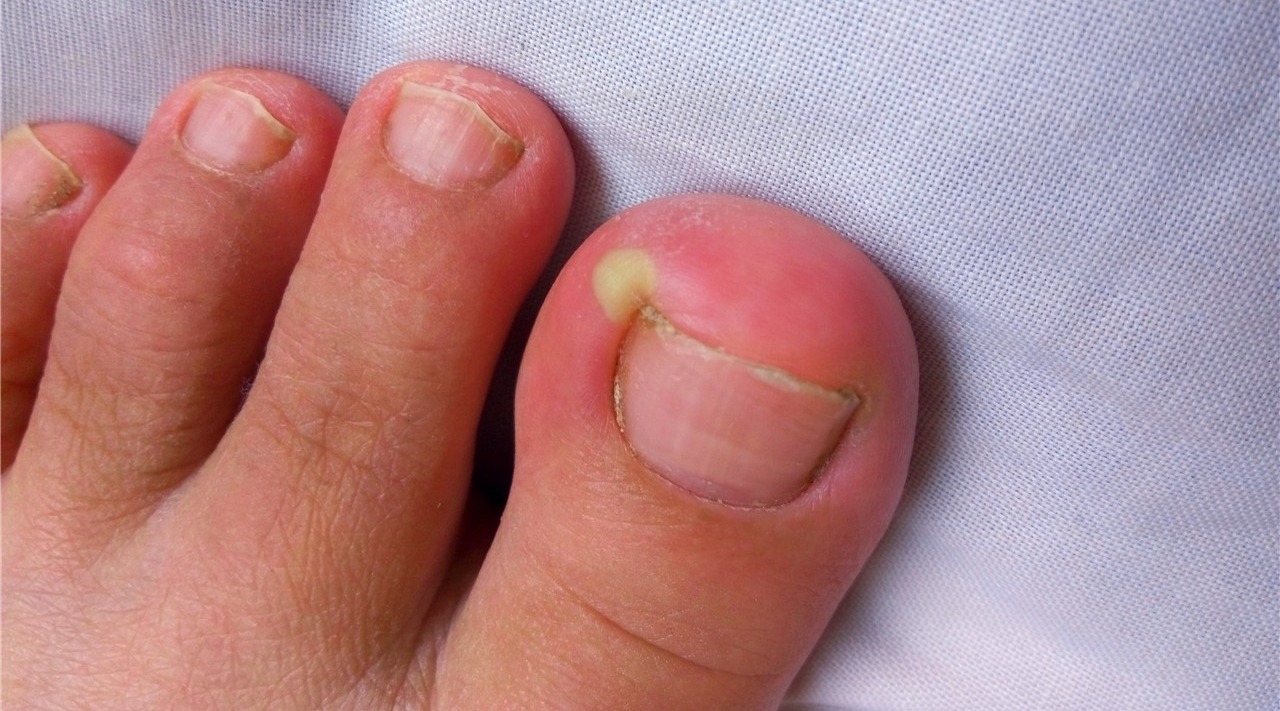 为什么那么多人的脚趾甲,都会长到肉里面去呢?