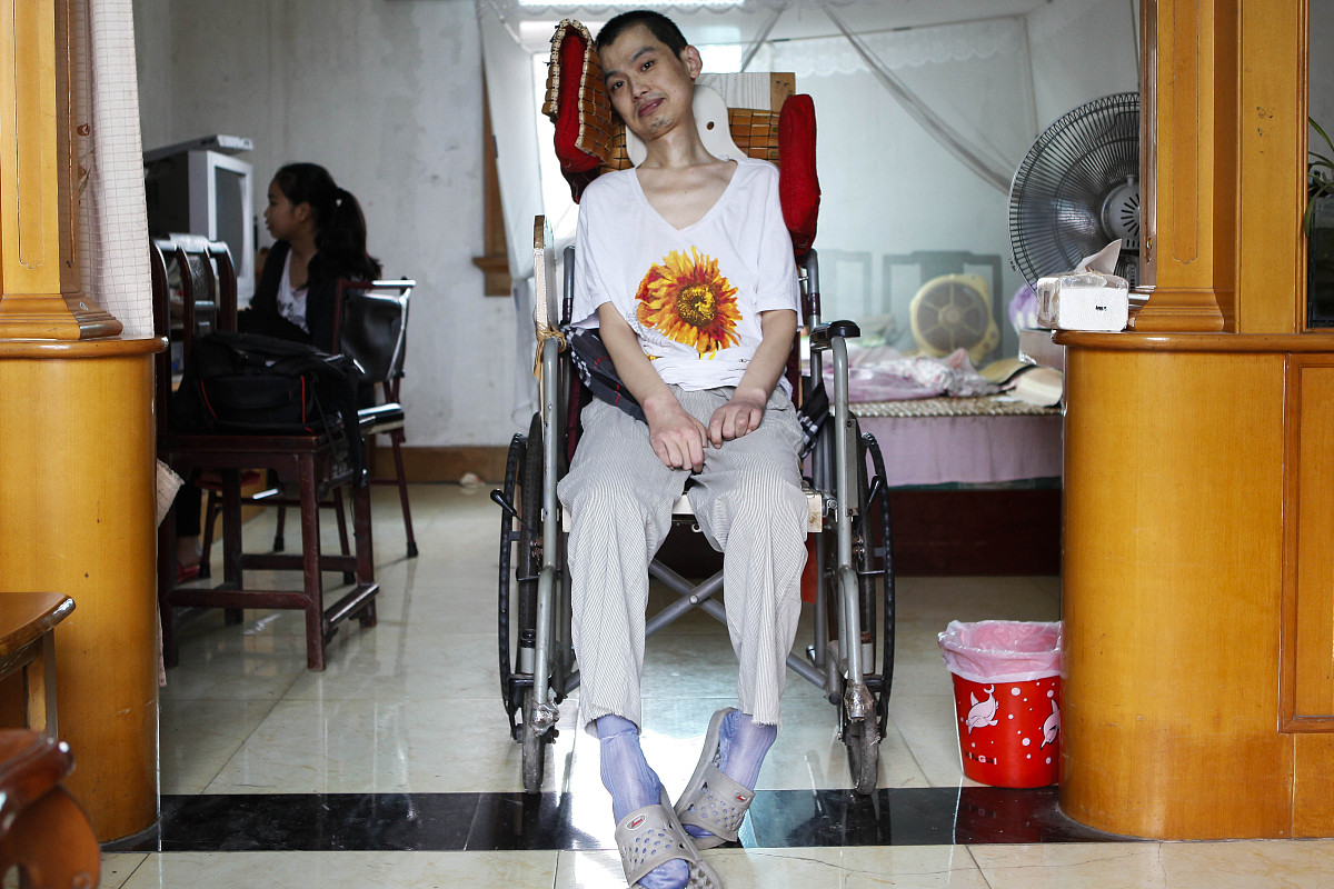 渐冻症发展全程