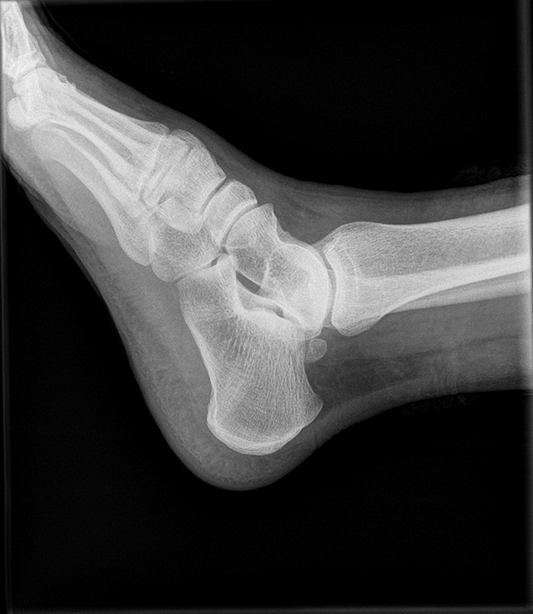 区分软骨瘤和非典型软骨瘤/软骨肉瘤的放射学评分系统