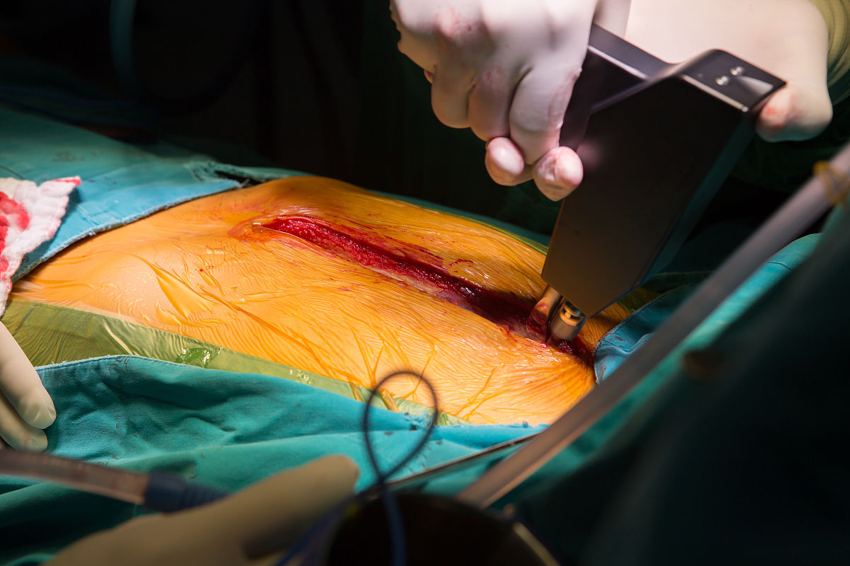 suture close sternotomy incision