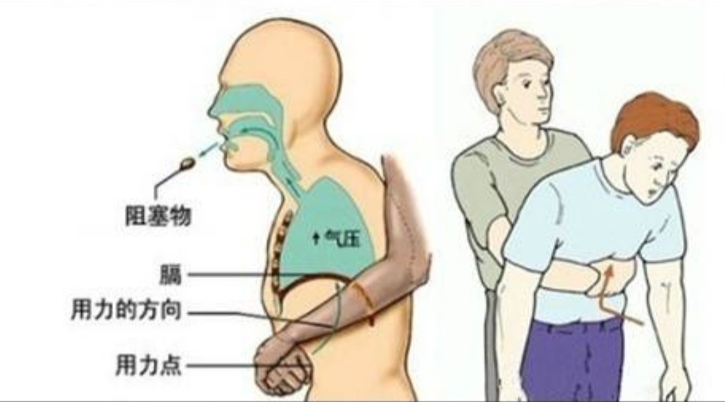 [图]6岁男童吃花生被呛住窒息,专家教你“海姆立克急救法”!