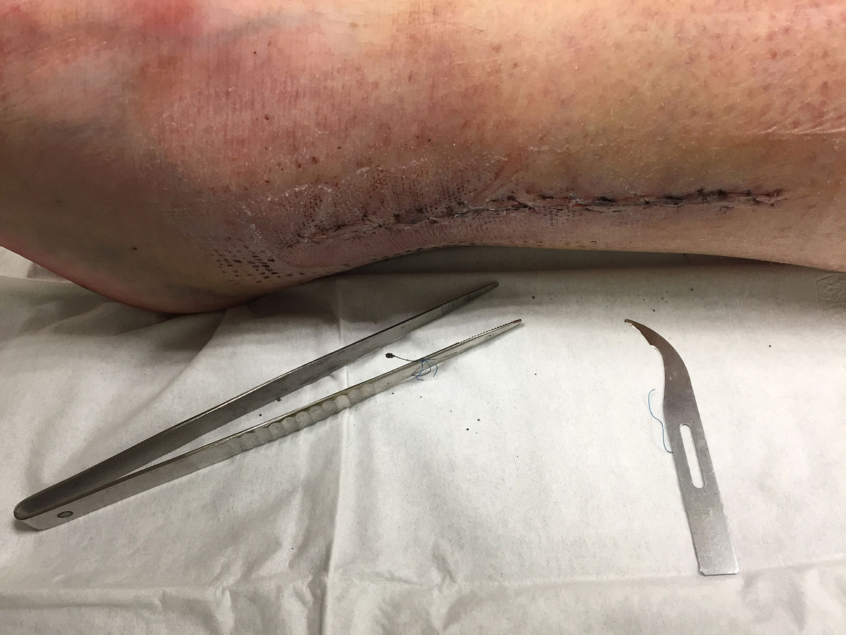 电刀和激光哪个恢复快，