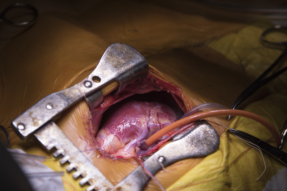 肝内胆管结石伴胆管炎患者腹腔镜手术术前心理调节