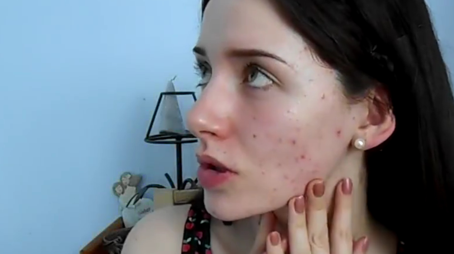 人体那么多地方,为什么痘痘偏偏喜欢长脸上?这其中并不简单