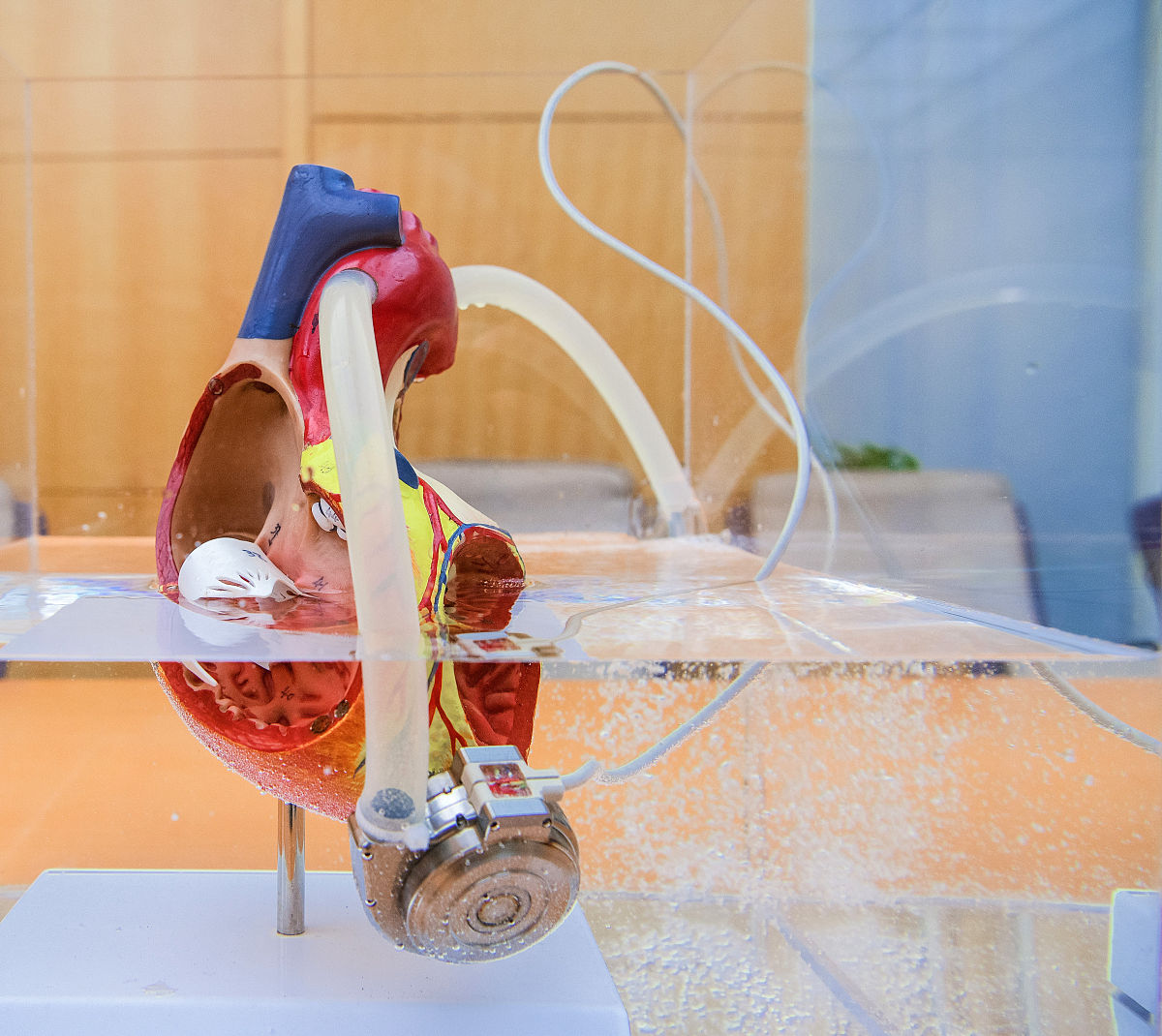 心衰指标1000多意味着什么？| 心脏功能指标详解