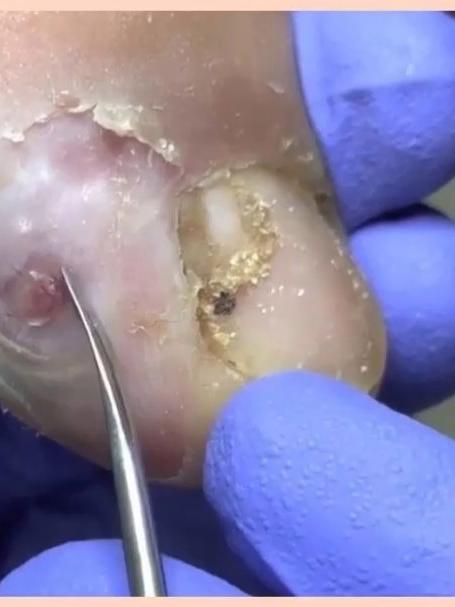 重庆皮肤病医院：手足长跖疣？千万别自行处理！