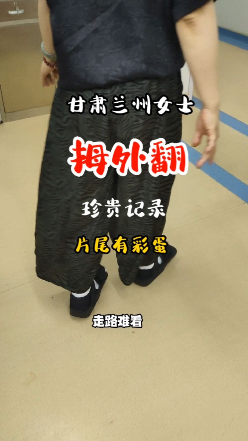 拇外翻到底带来了多少并发症?鸡眼,拇囊炎 #拇外翻 #大脚骨 #微创大脚骨