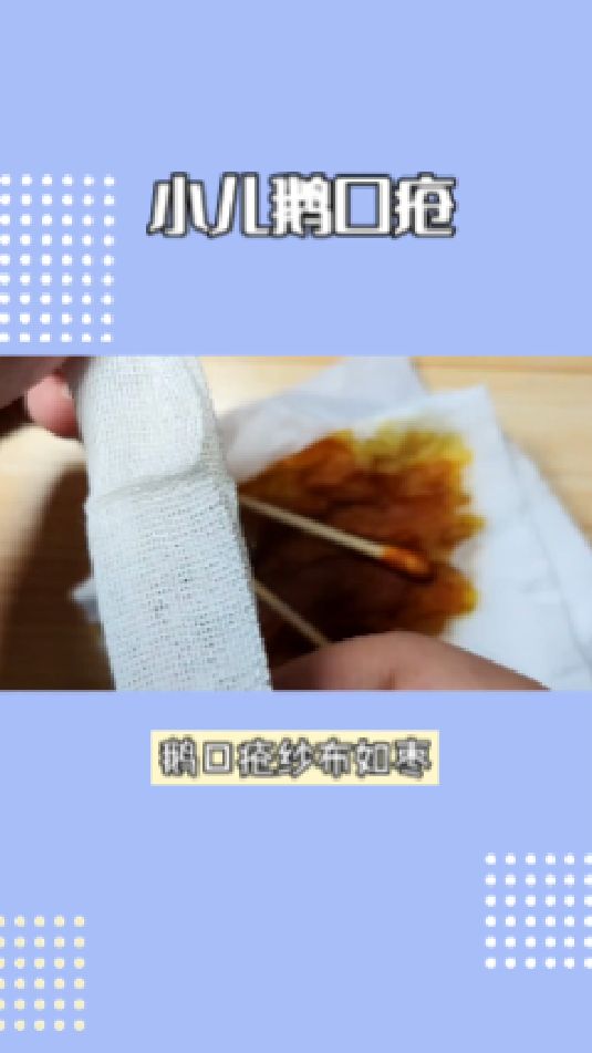 治疗小儿鹅口疮方法