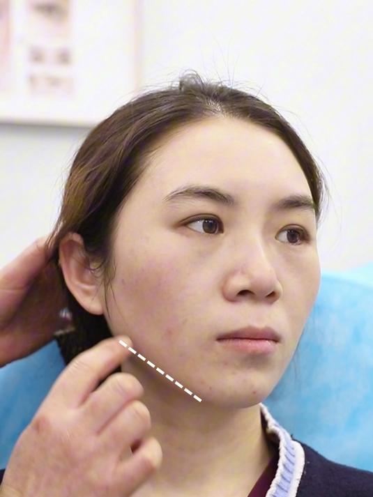 解救垮脸你不知道的肉毒全脸提升打法