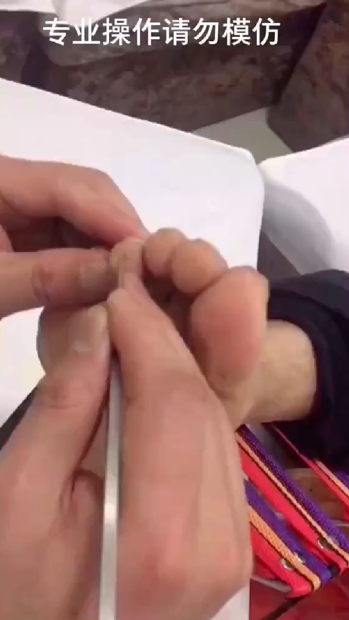 专业修脚鸡眼老茧