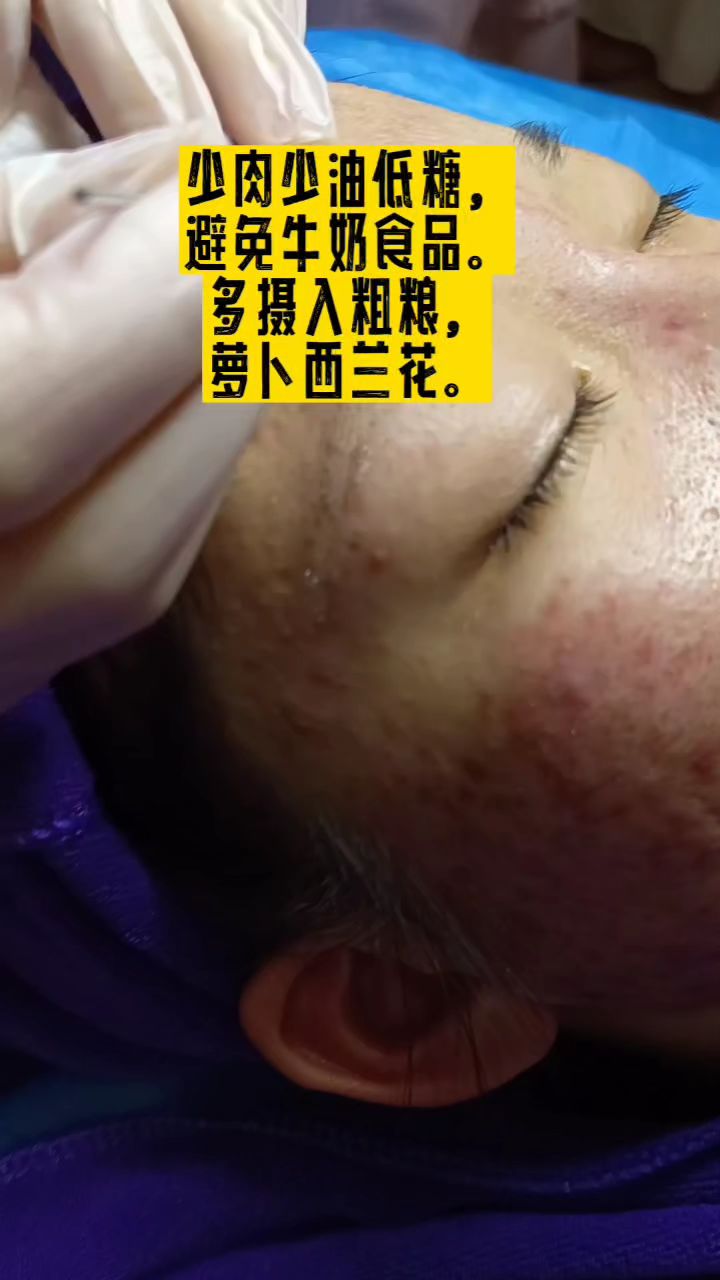 毛囊皮脂腺的慢性炎症,粉刺,丘疹,脓包怎么办?
