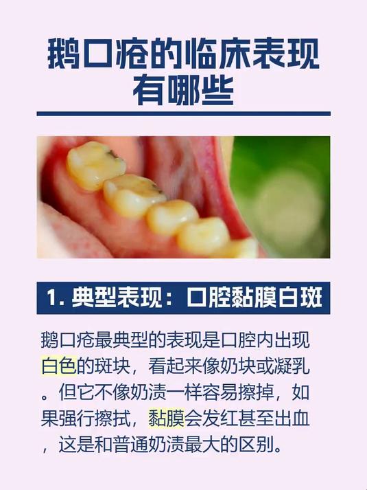 鹅口疮的临床表现有哪些