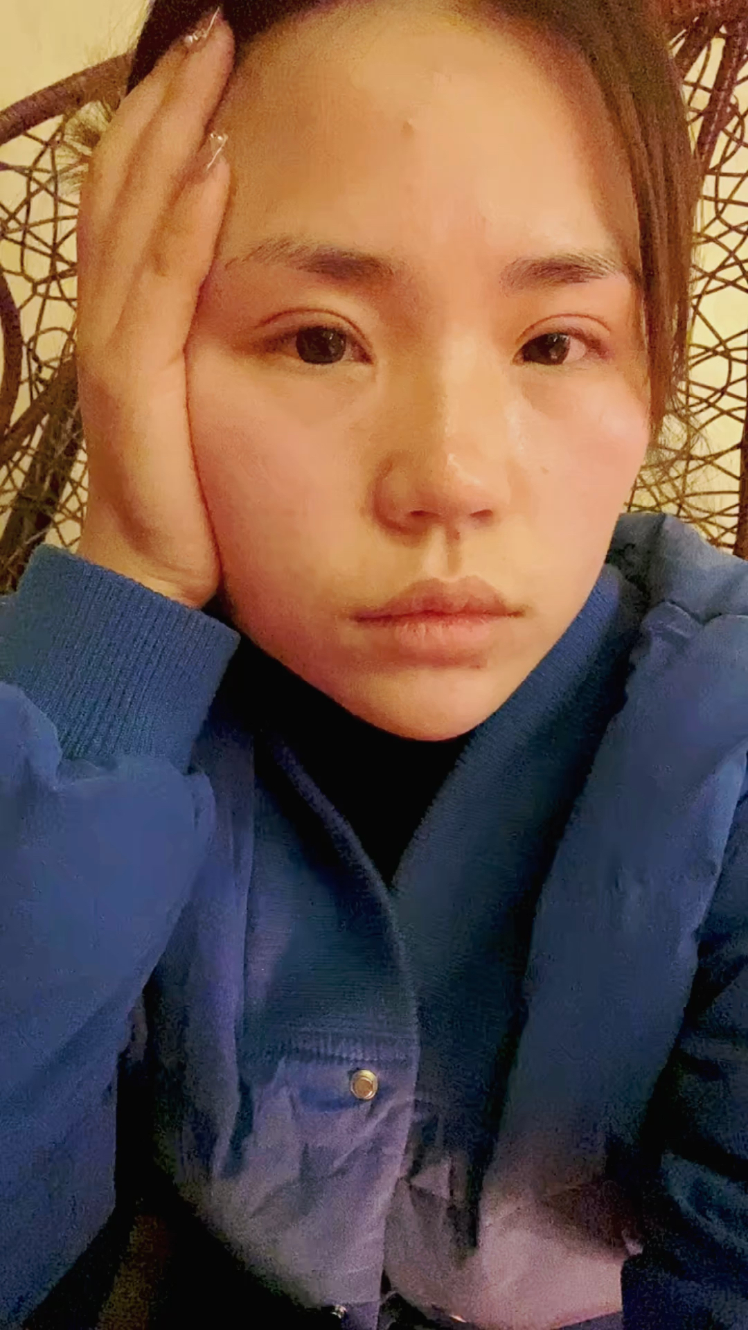 全切双眼皮9个月了肉条还是很重,身边的人都说很假