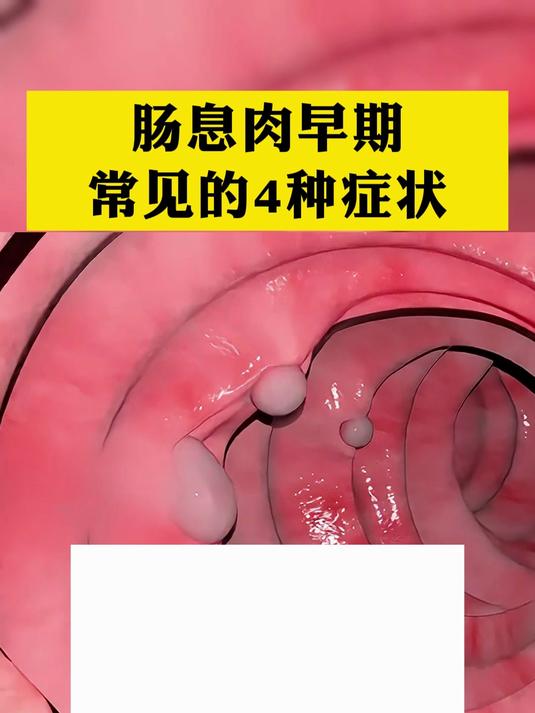 肠息肉早期常见的4种症状