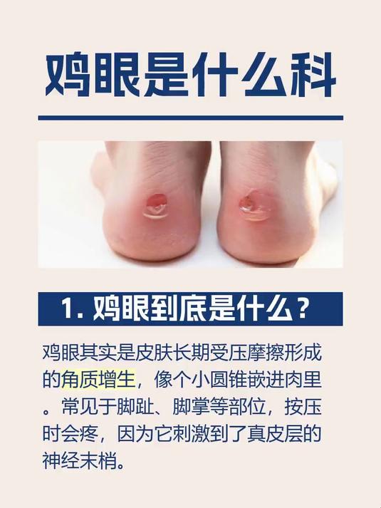鸡眼是什么科