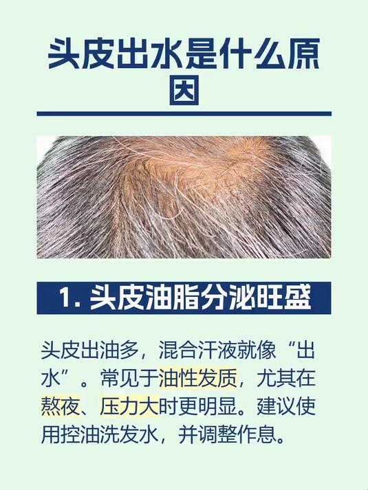 #马上健康过大年#头皮出水是什么原因
