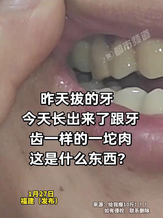 拔完牙长出了跟牙齿一样的一坨肉,牙医:这明胶海绵太完美了