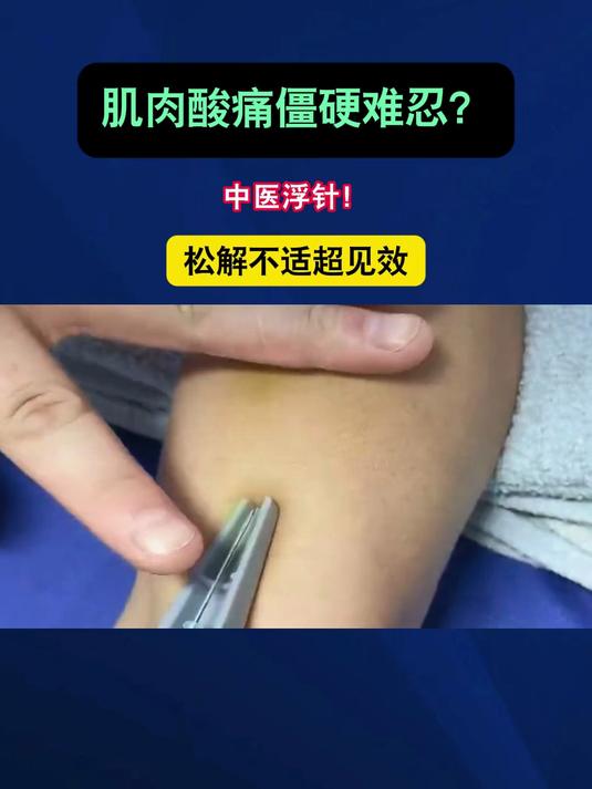 肌肉酸痛僵硬难忍?中医浮针!松解不适超见效