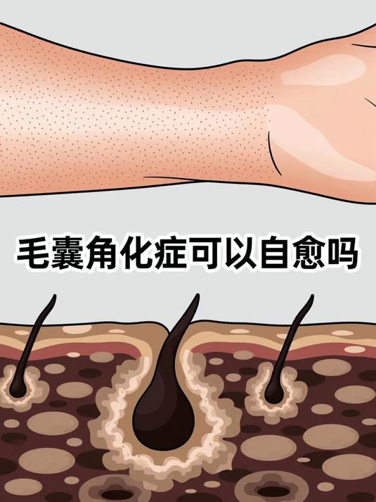 毛囊角化症可以自愈吗