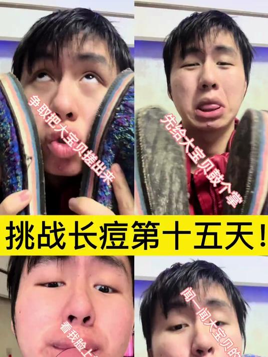 第16集|挑战长痘第15天!护肤 痘痘 挑战长痘