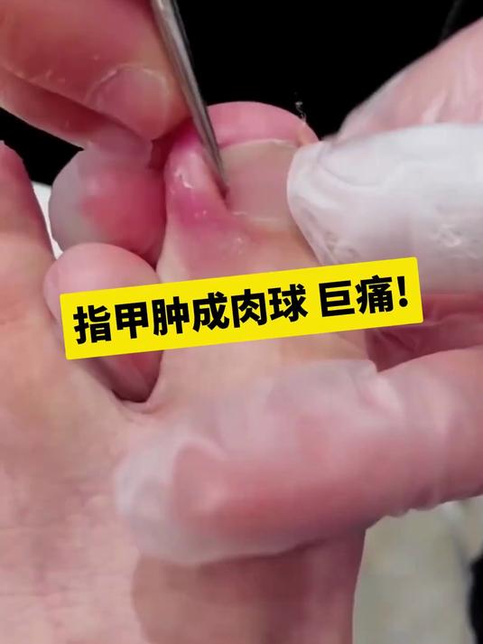 指甲厚，甲沟长肉刺肿成球？试试专用指甲钳！肉刺倒刺轻松处理！