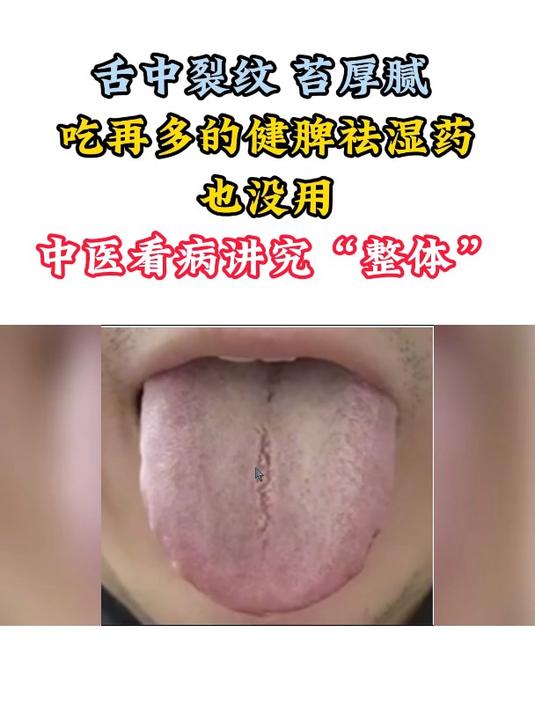 舌中裂纹,苔厚腻,吃再多的健脾祛湿药也没用!中医看病讲究整体