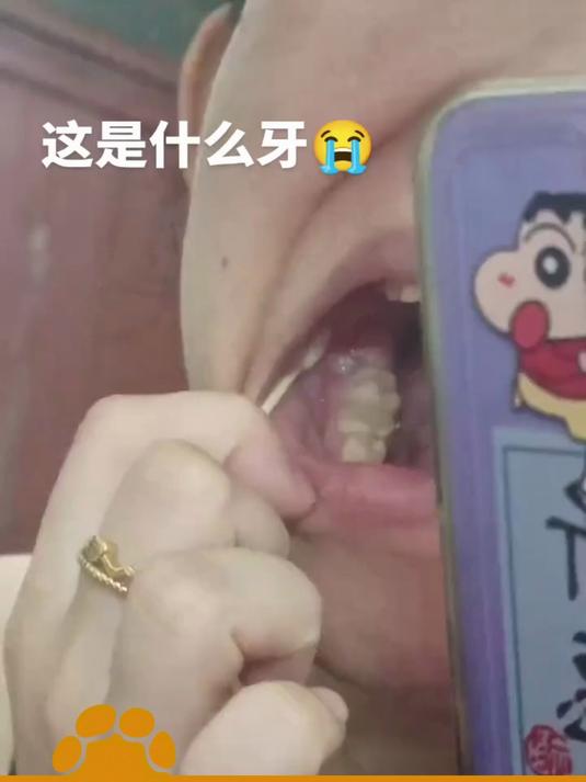 女生以为是牙肉肿痛,检查完发现是横向长的智齿