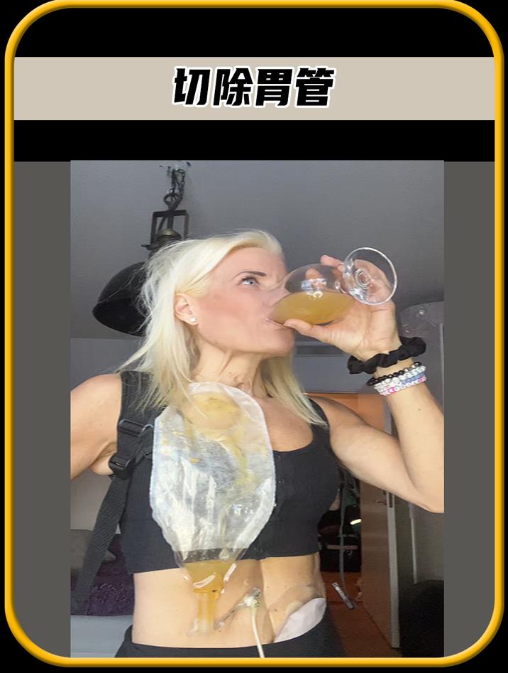 你知道一个人在没有胃管的情况下,该怎么进食获取营养呢